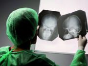 Epilessia, basta pregiudizi