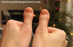 Mai più soli con la Sindrome di Klinefelter