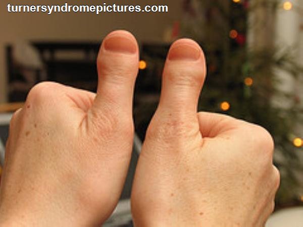 What-Is-Klinefelter-Syndrome