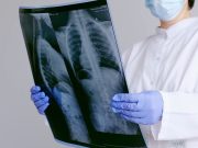 Tumori rari, i sarcomi richiedono diagnosi tempestive e alta specializzazione